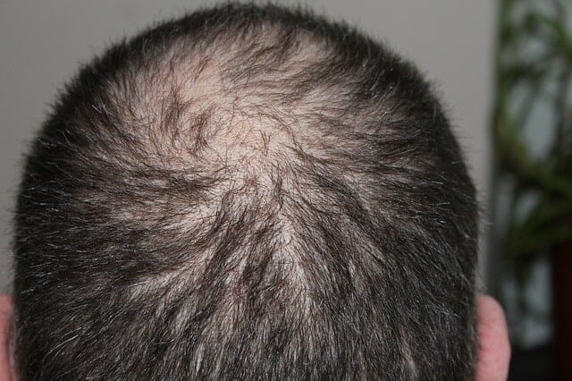 Alopecia androgénica