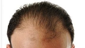 alopecia, queda de cabelo