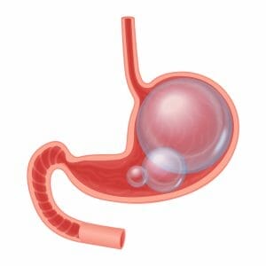  gráfico que representa um estômago e intestinos inchados 