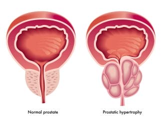  hipertrofia da próstata